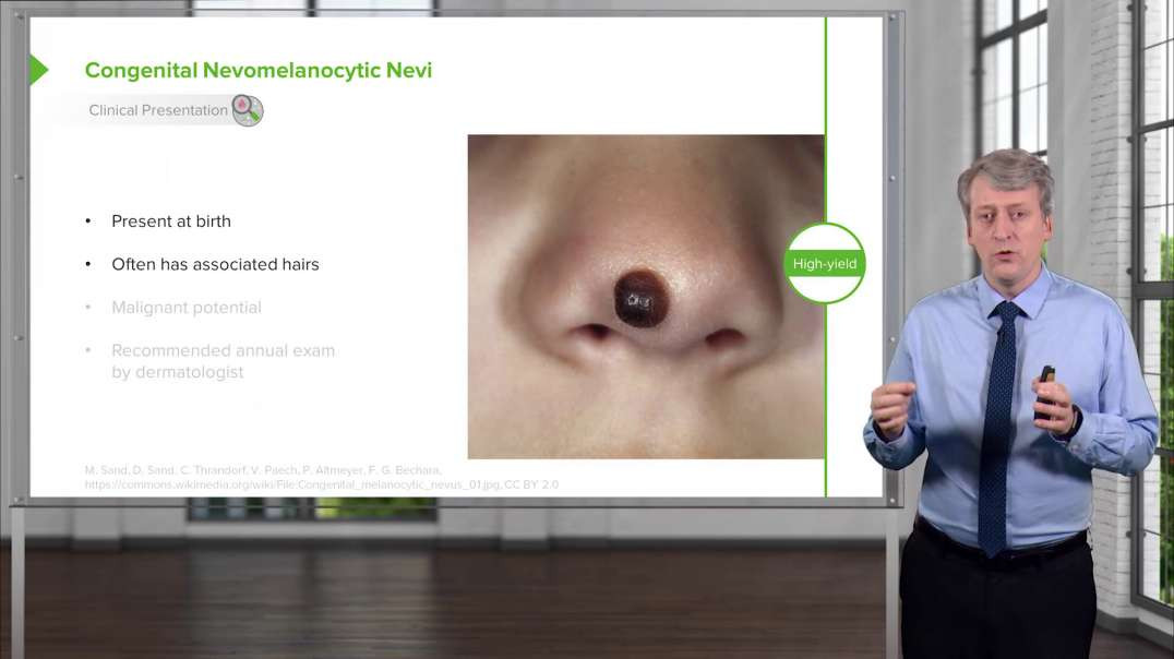 Lecturio Nevus (Moles) in Children