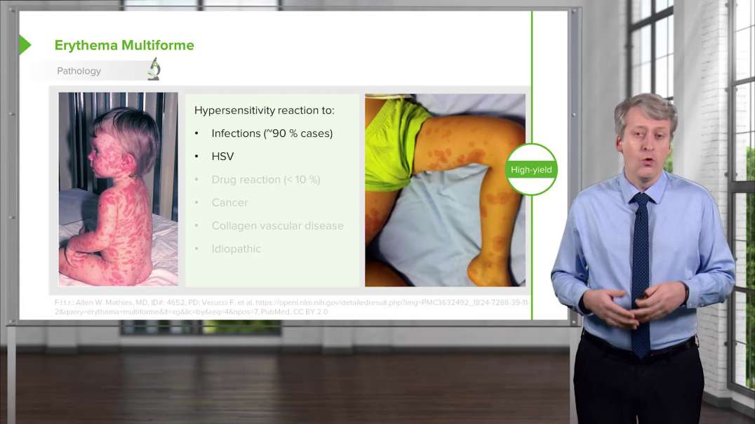 Lecturio - Erythema Multiforme and Stevens-Johnson Syndrome (SJS) in Children