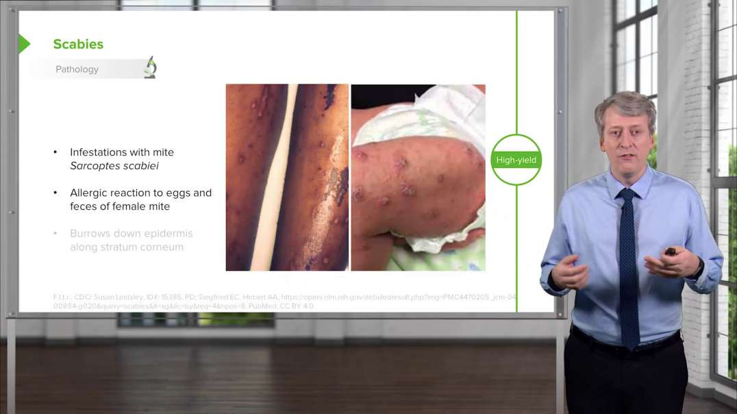 Lecturio - Scabies, Head Lice (Pediculosis Capitis) and Tinea Corporis (Ringworm) in Children