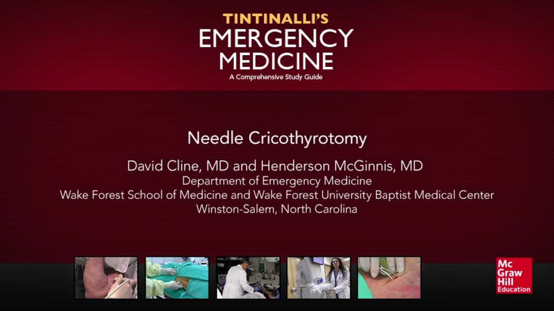 Needle Cricothyrotomy