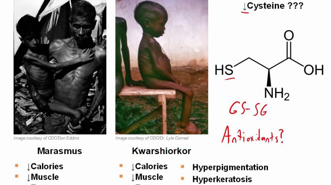 Protein-Energy Malnutrition