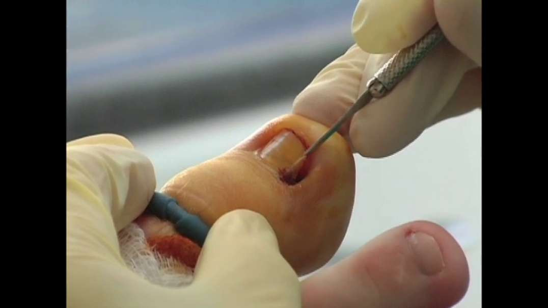 Ingrown Toenail Removal