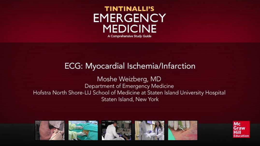 ECG Myocardial Ischemia Infarction