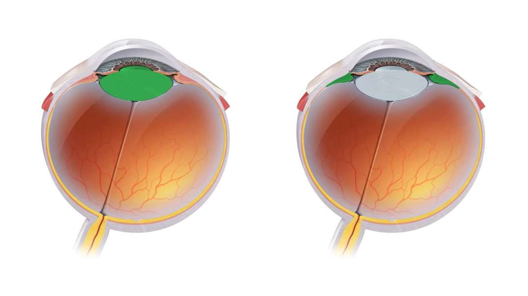 Lens and corpus ciliare