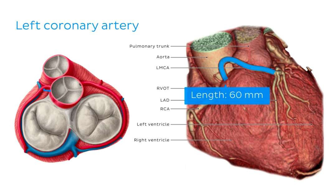 Clinical cases - Long ectopic left main coronary artery
