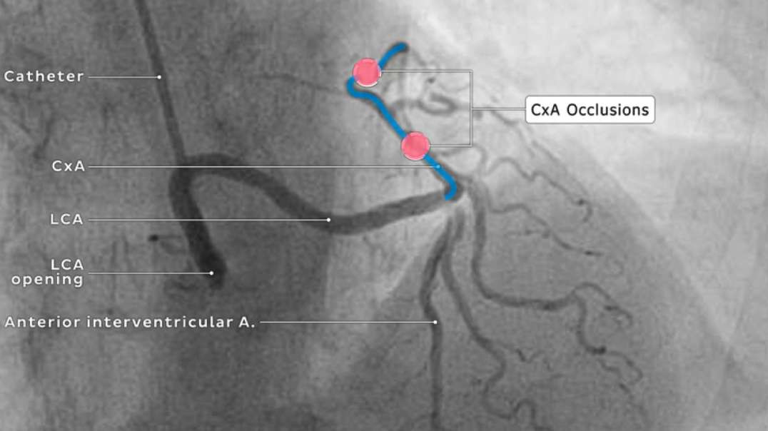 Clinical cases - Long ectopic left main coronary artery