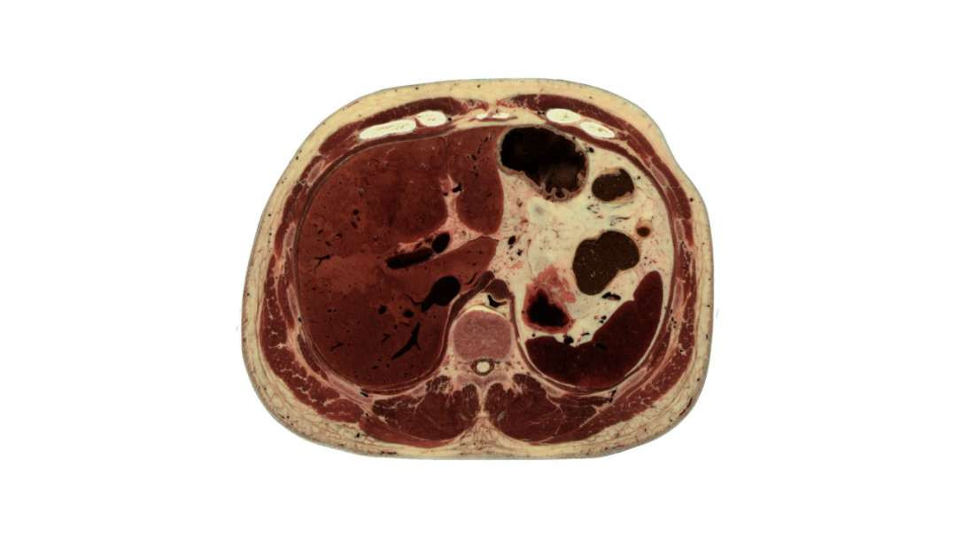 11th Thoracic vertebra level