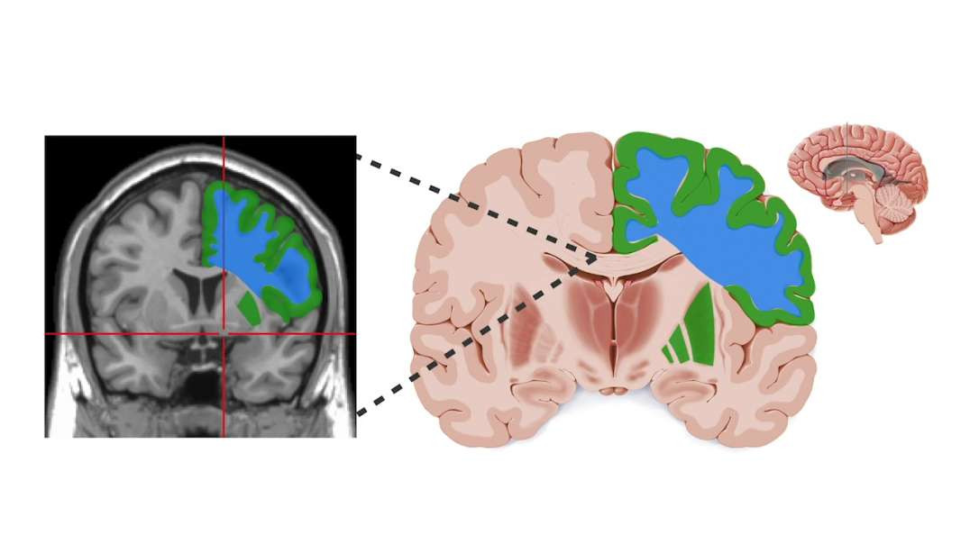Coronal section of the brain at the level of the thalamus